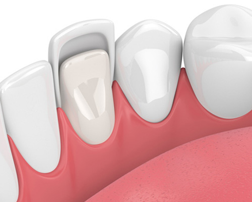 Ceramic Veneers in Vijayawada