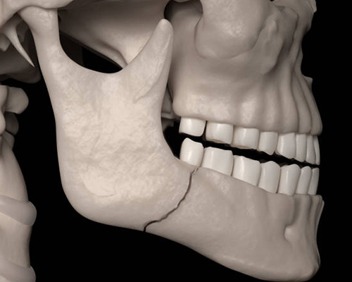 Fractures of Maxilla and Mandible