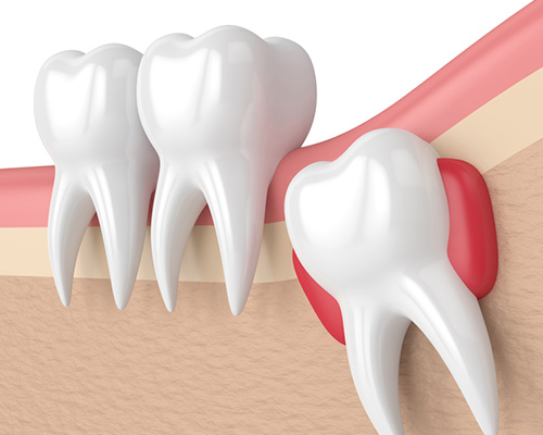 impactions and-extractions in vijayawada