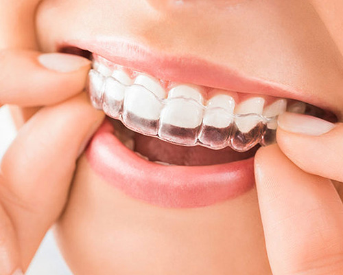 Invisible Braces in Vijayawada