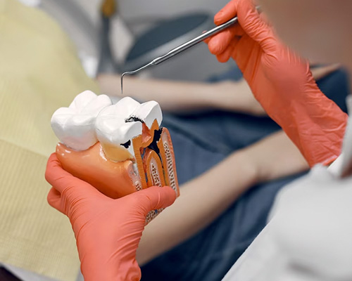 Painless Root Canal Treatment in Vijayawada