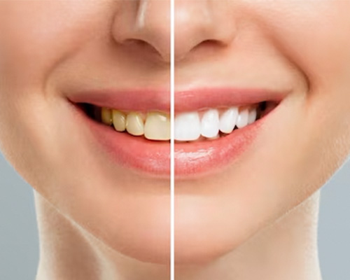 teeth whitening in Vijayawada